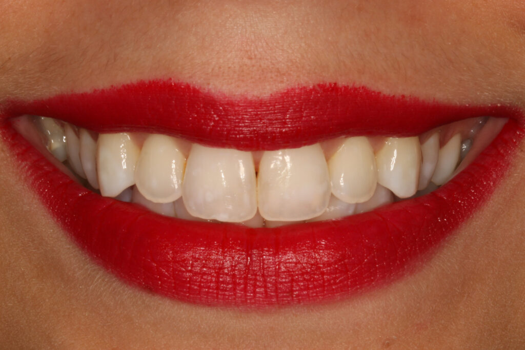 λεύκανση μετά