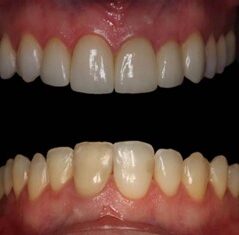 όψεις ρητίνης/πορσελάνης