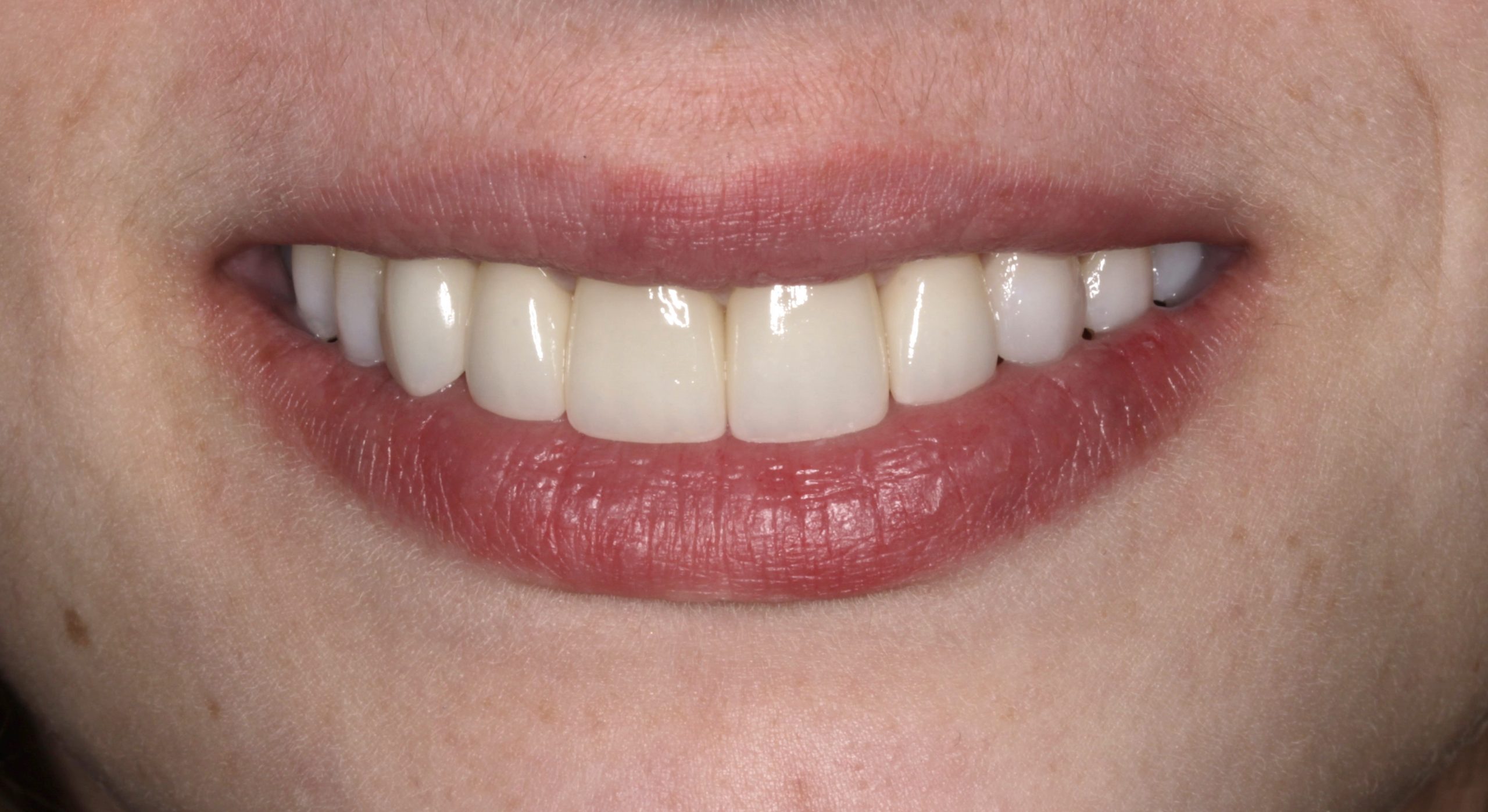 Βελτίωση χαμόγελου με όψεις πορσελάνης μετά