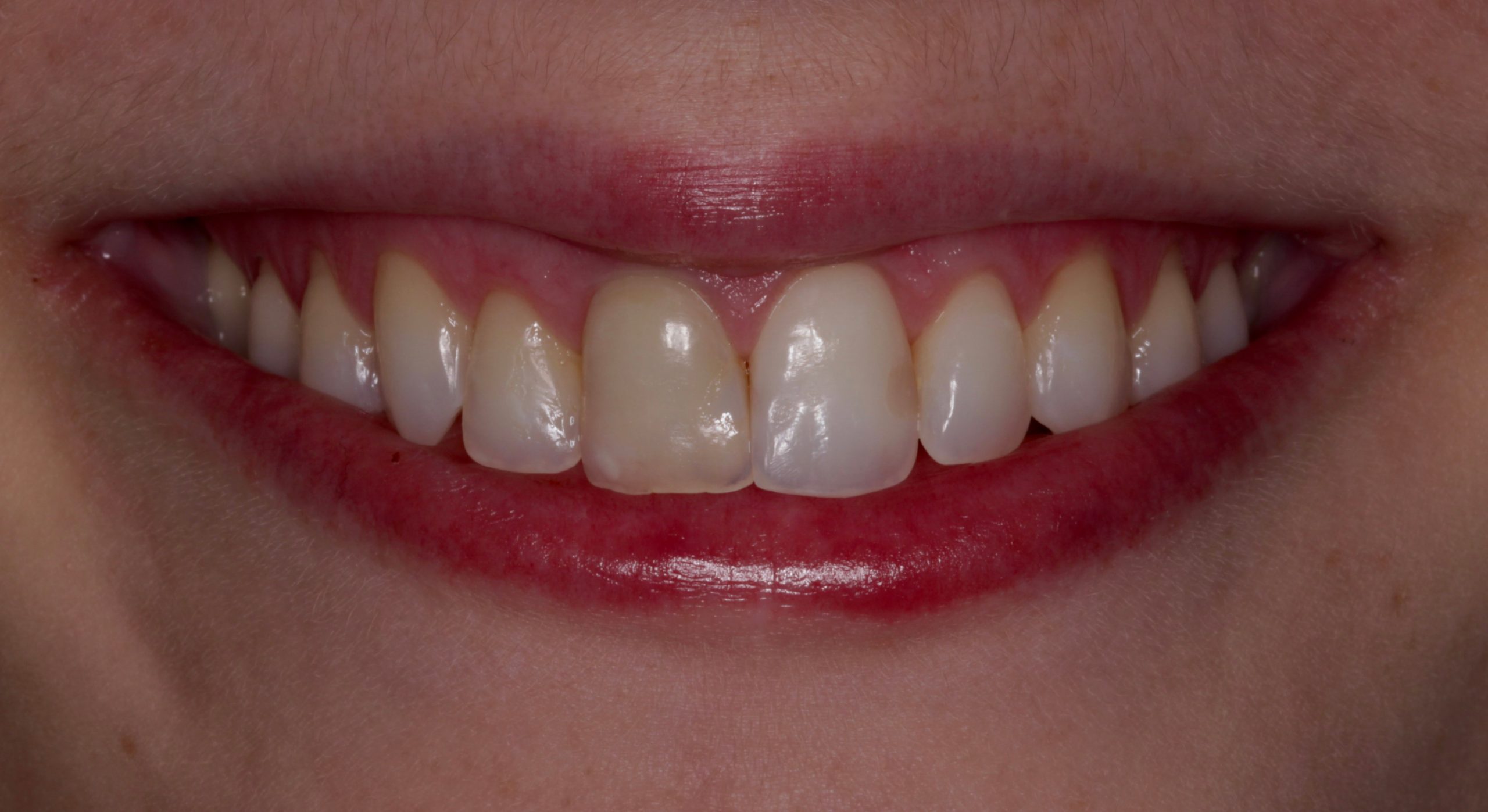 Βελτίωση χαμόγελου με όψεις πορσελάνης πριν