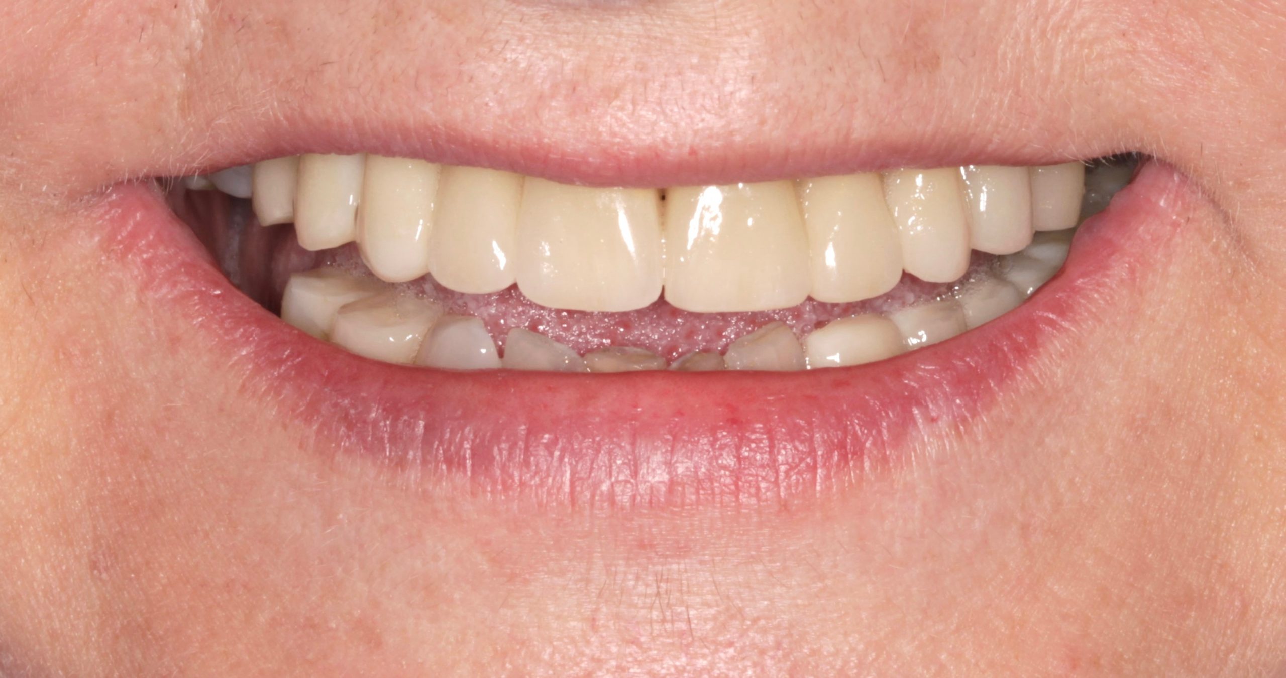 Ολική αποκατάσταση με εμφυτεύματα μετά