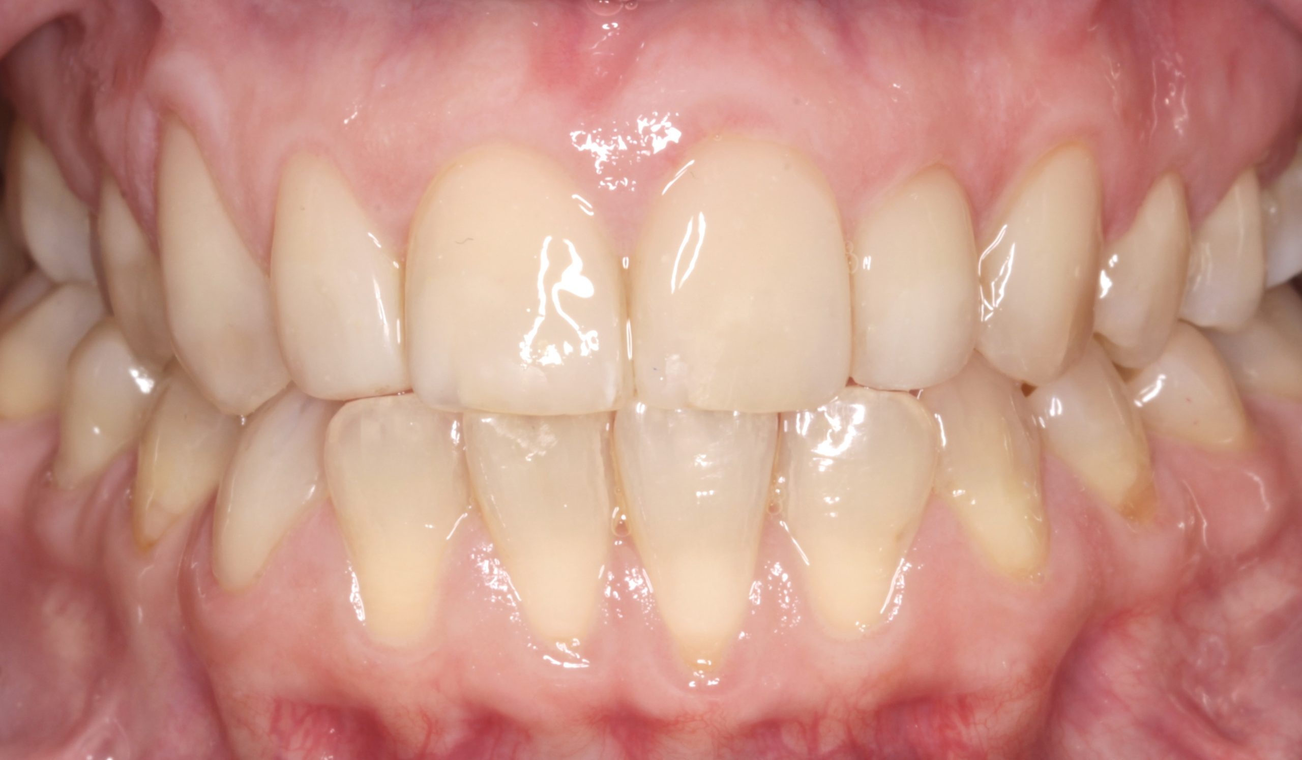 Αποκατάσταση εκτεταμένων διαβρώσεων με σύνθετη ρητίνη μετά