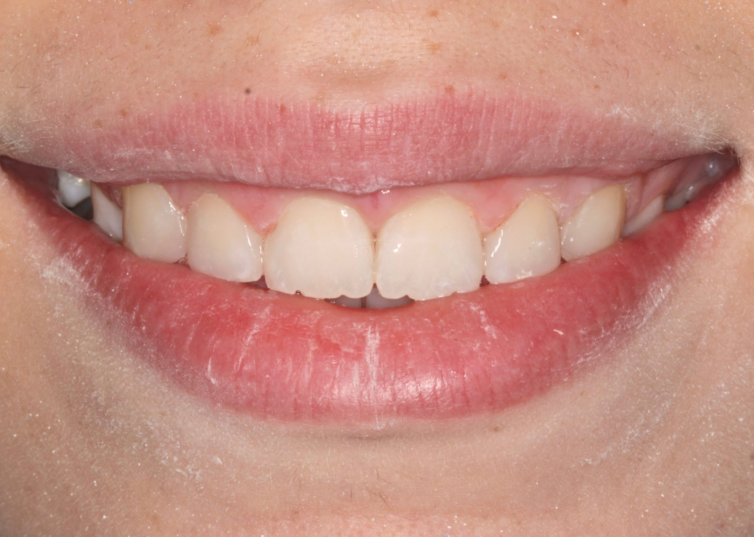 Κλείσιμο διαστημάτων με σύνθετη ρητίνη μετά