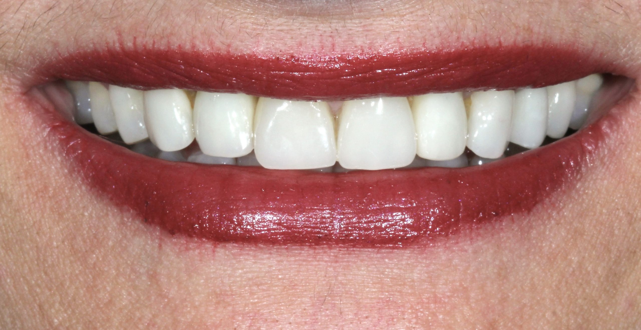 Αποκατάσταση με εμφυτεύματα και όψεις πορσελάνης μετά