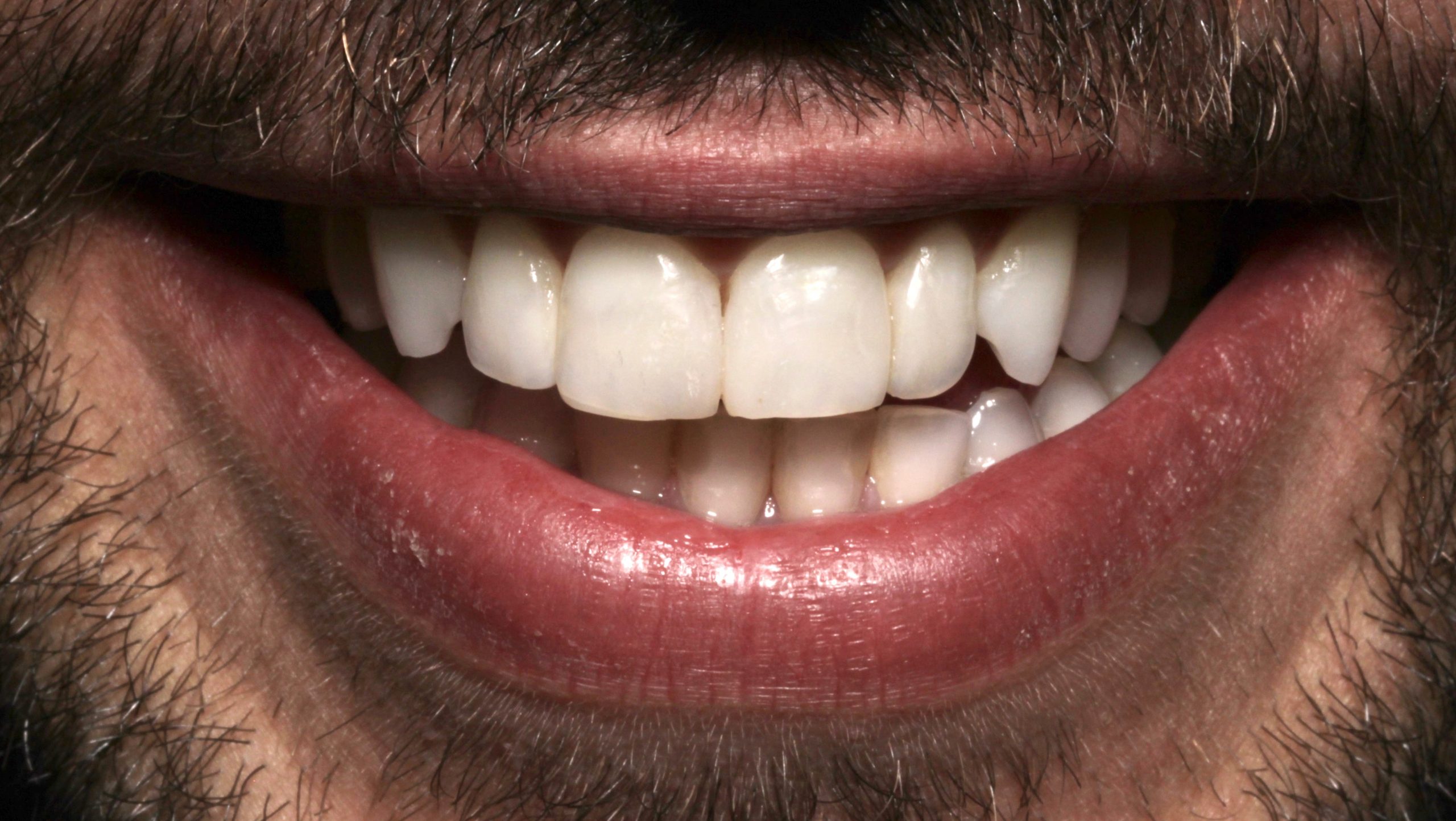 Βελτίωση χαμόγελου με όψεις σύνθετης ρητίνης μετά