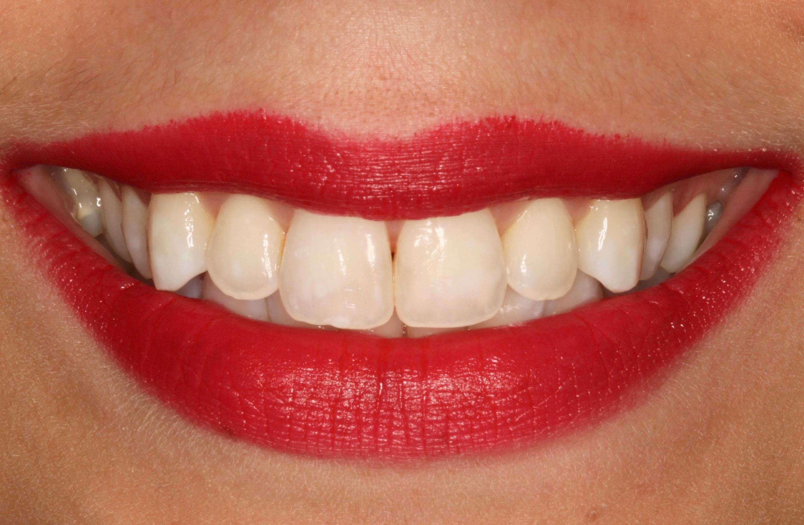 λεύκανση μετά