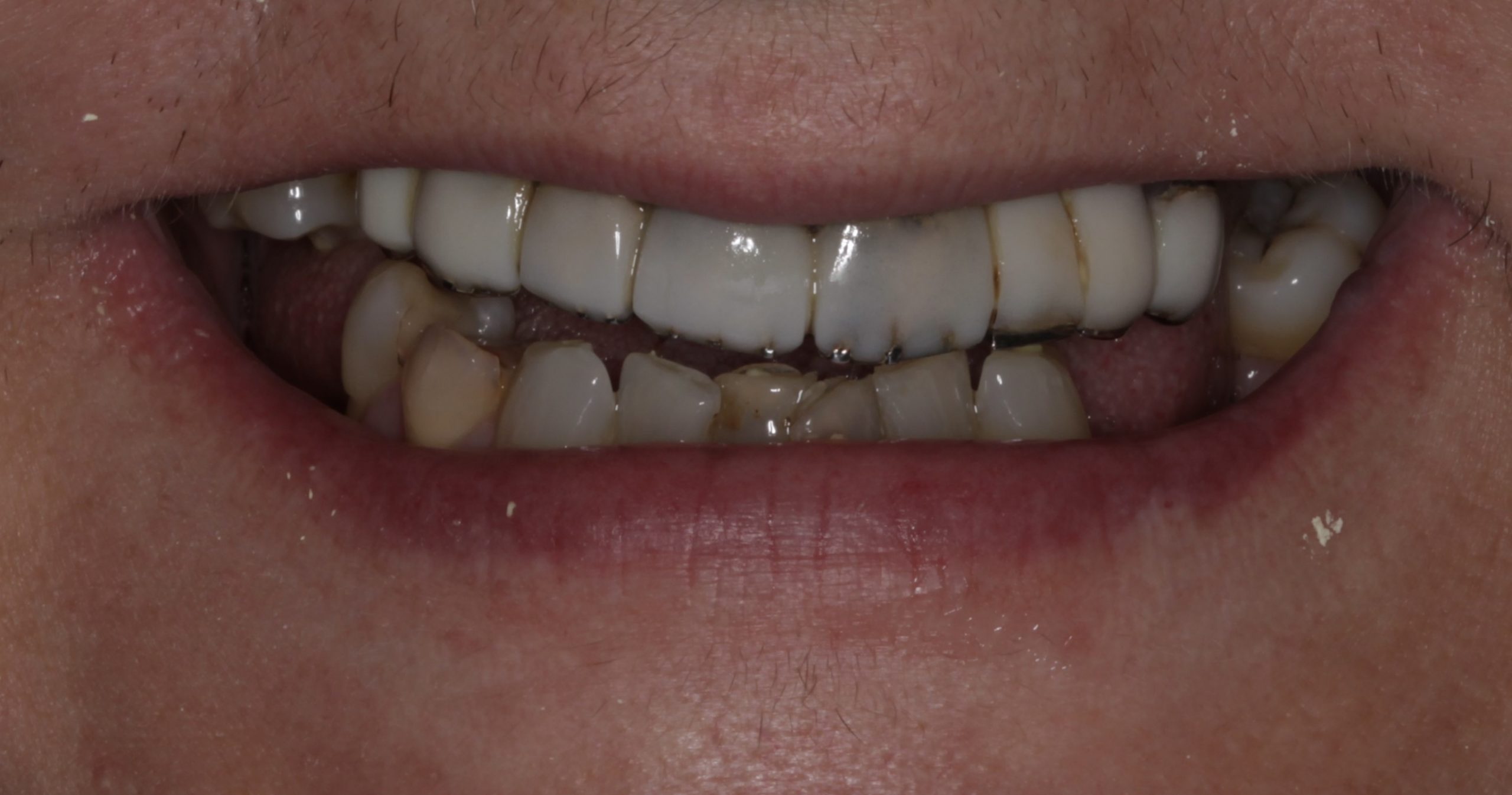 Ολική αποκατάσταση με εμφυτεύματα πριν