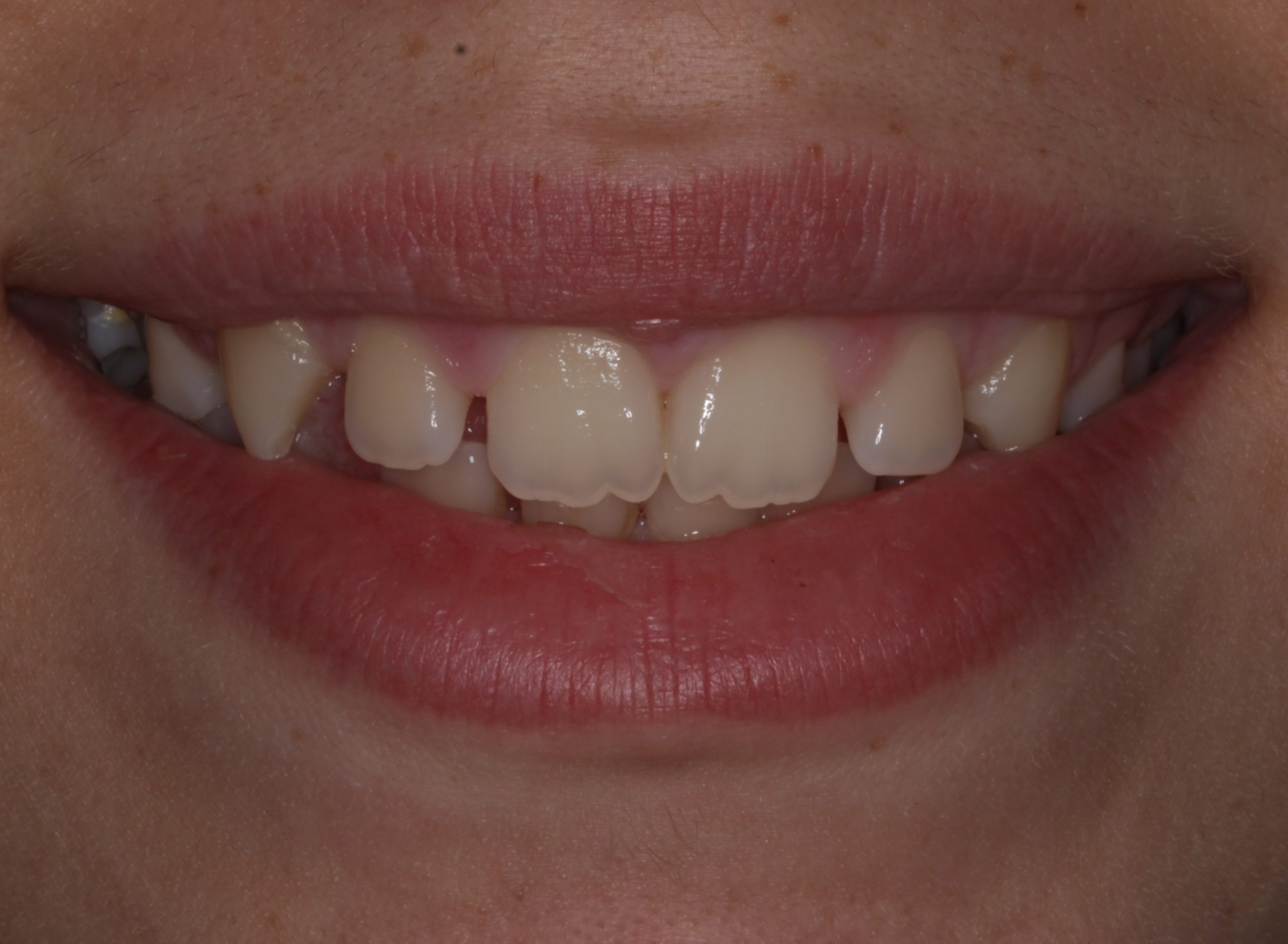 Κλείσιμο διαστημάτων με σύνθετη ρητίνη πριν