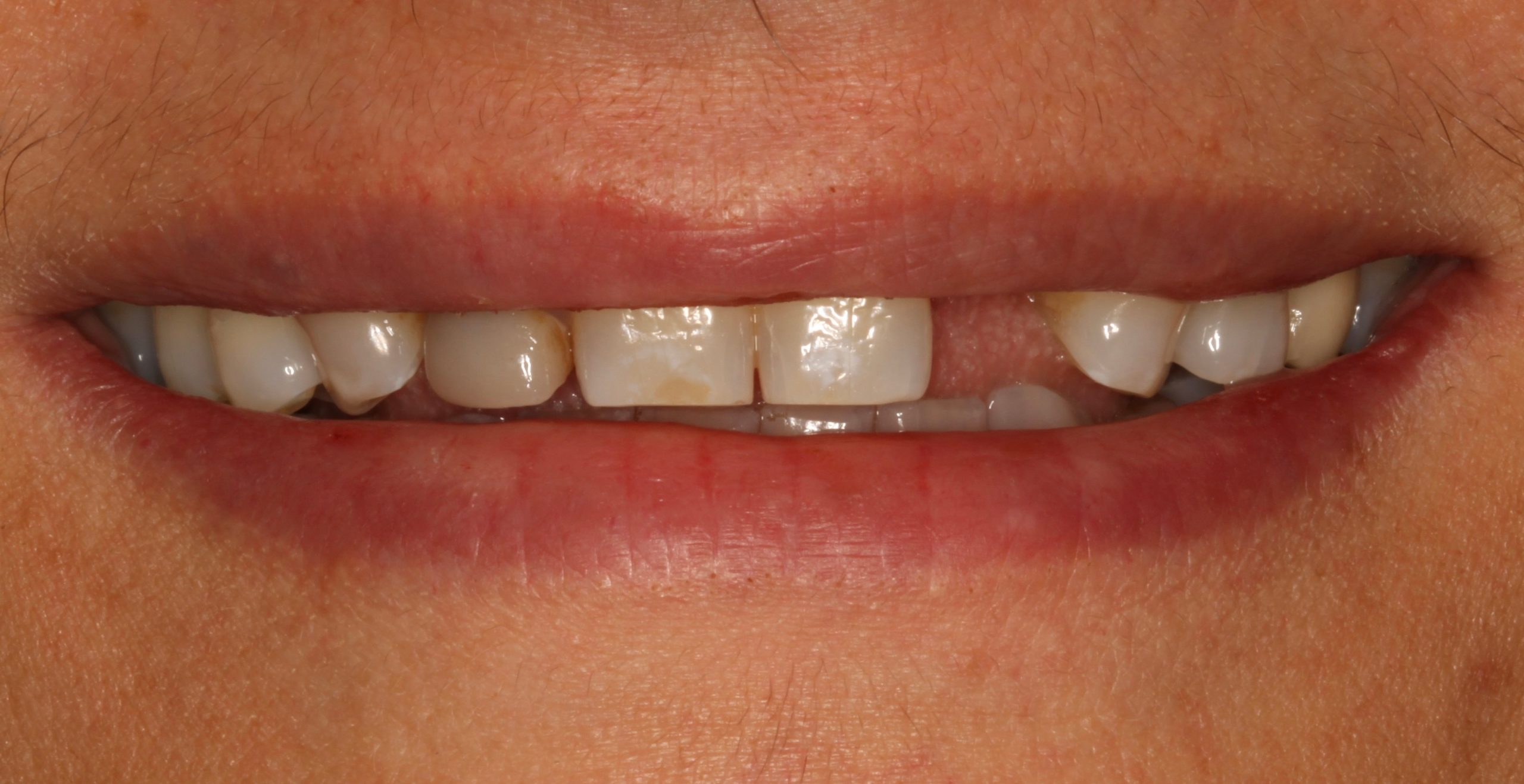 Αποκατάσταση με εμφυτεύματα και όψεις πορσελάνης πριν