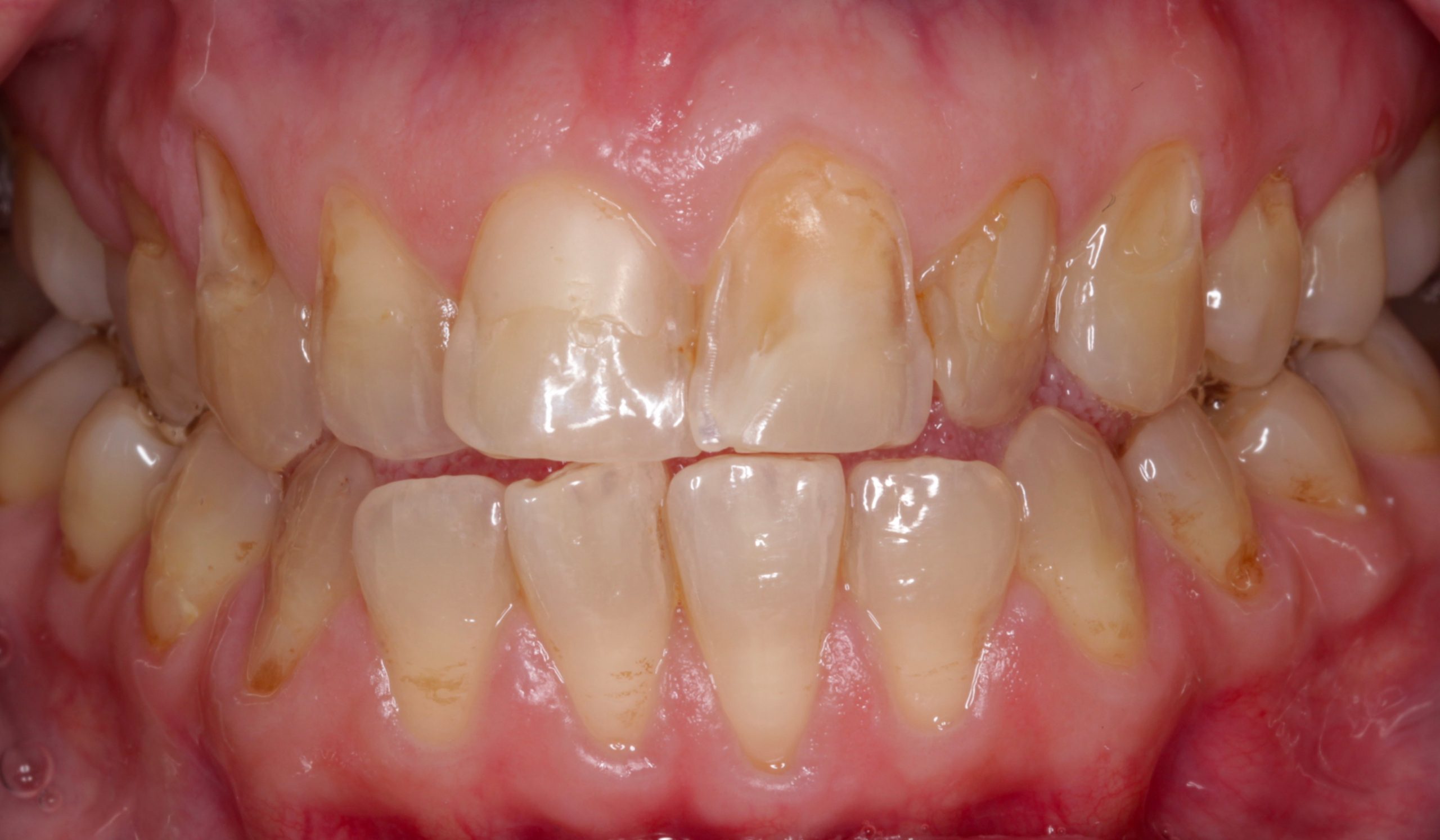 Αποκατάσταση εκτεταμένων διαβρώσεων με σύνθετη ρητίνη πριν