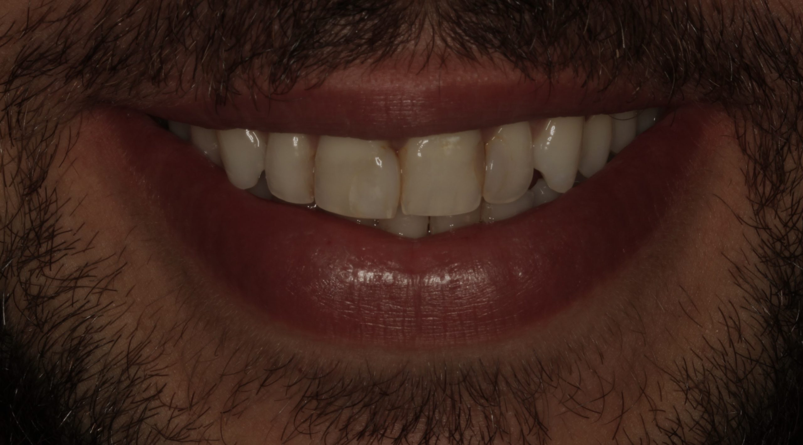 Βελτίωση χαμόγελου με όψεις σύνθετης ρητίνης πριν