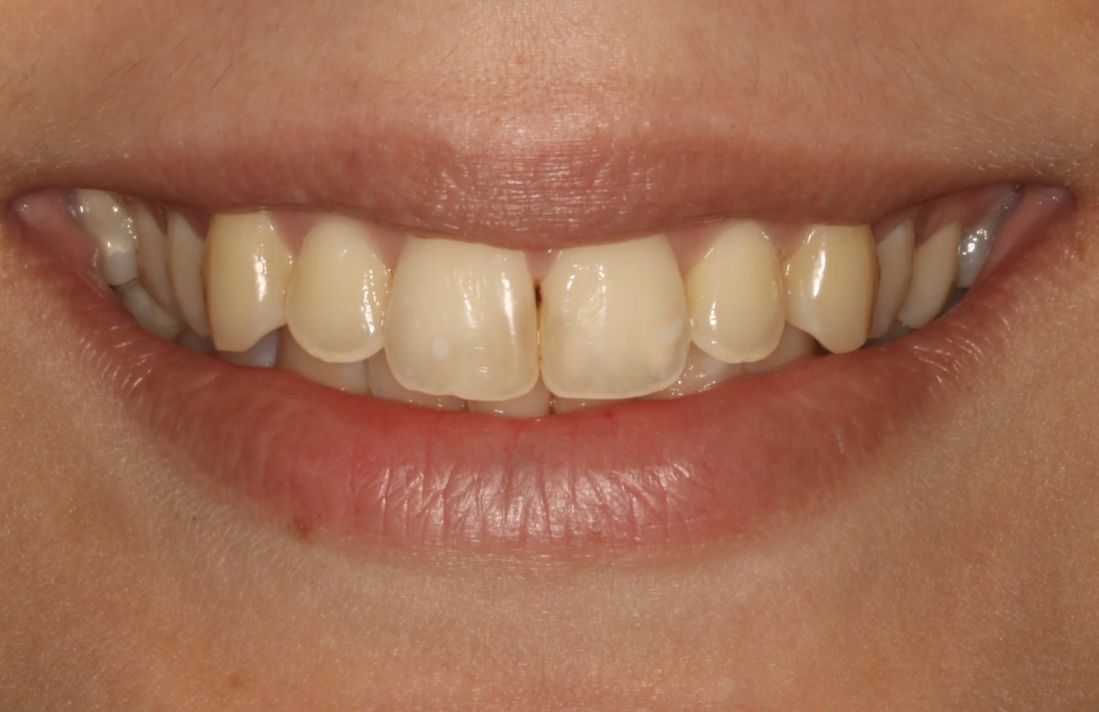 λεύκανση πριν