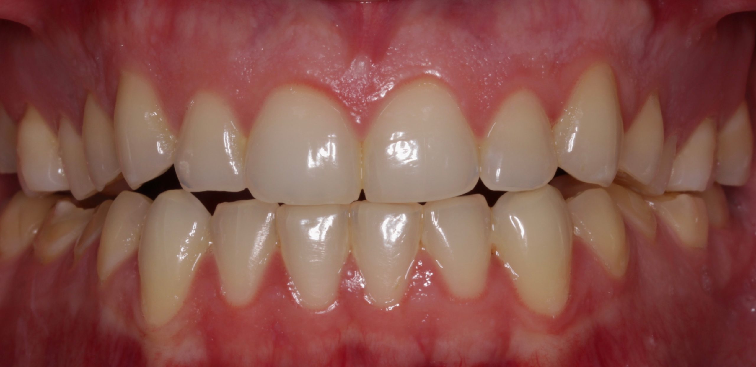 Αντιμετώπιση εκτεταμένων αποτριβών πριν