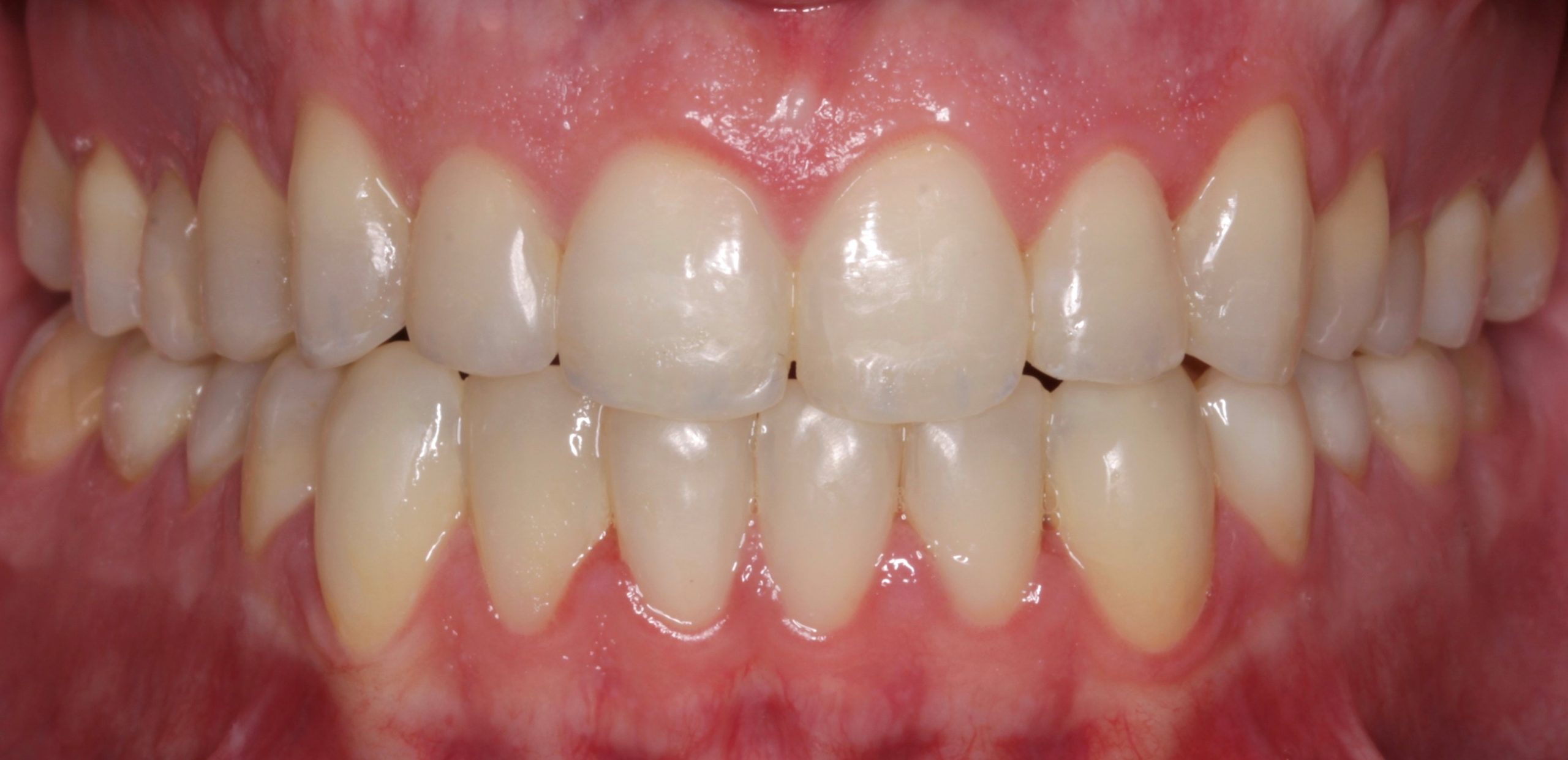 Αντιμετώπιση εκτεταμένων αποτριβών μετά