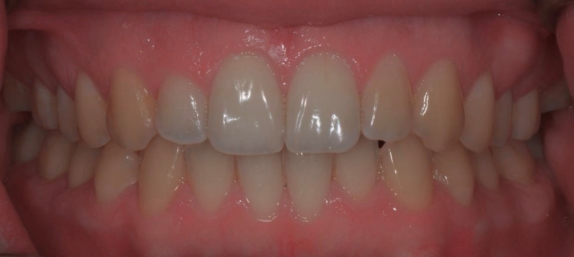 λεύκανση 2 πριν