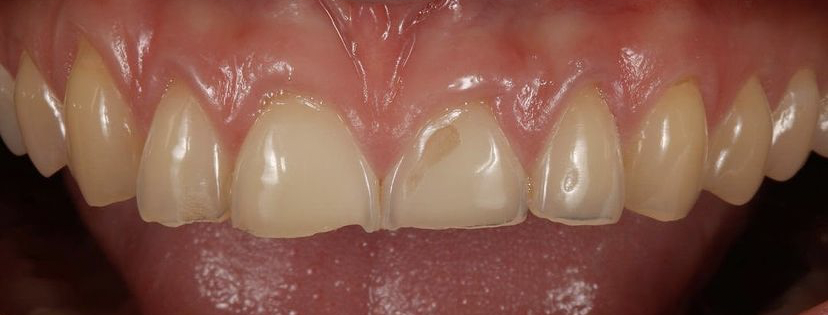 Αποκατάσταση εκτεταμένων διαβρώσεων με σύνθετη ρητίνη 2 πριν