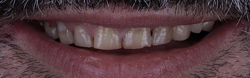 Αντιμετώπιση εκτεταμένων αποτριβών 2 πριν