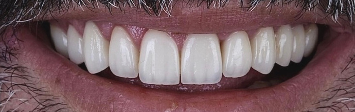 Αντιμετώπιση εκτεταμένων αποτριβών 2 μετά