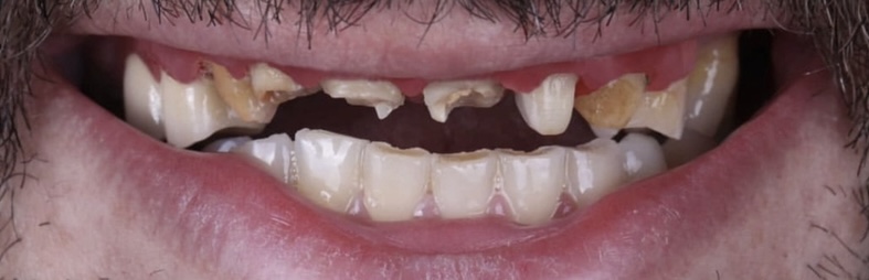 Ολική αποκατάσταση με εμφυτεύματα 2 πριν