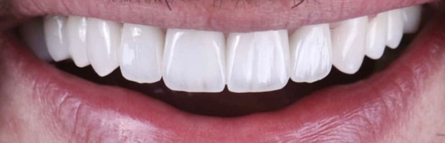 Ολική αποκατάσταση με εμφυτεύματα 2 μετά