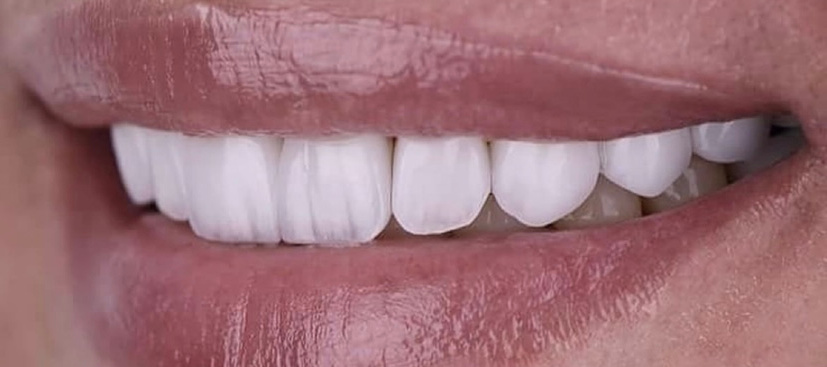 Αποκατάσταση με εμφυτεύματα και όψεις πορσελάνης 2 μετά