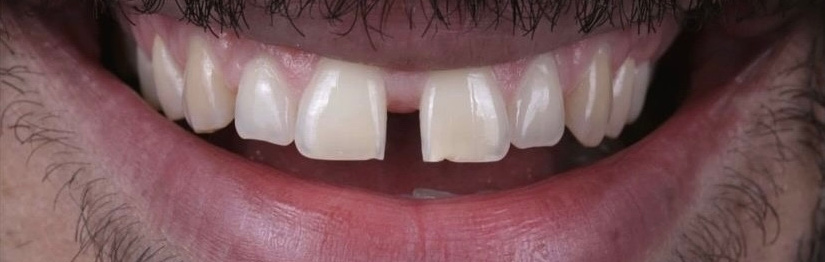 Βελτίωση χαμόγελου με όψεις σύνθετης ρητίνης 2 πριν