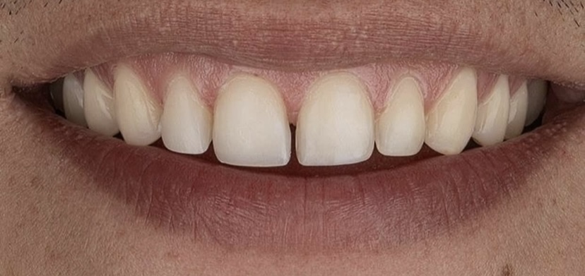 Κλείσιμο διαστημάτων με σύνθετη ρητίνη 2 πριν