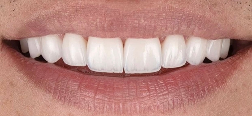 Κλείσιμο διαστημάτων με σύνθετη ρητίνη 2 μετά