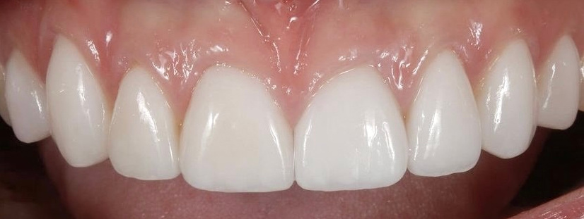 Αποκατάσταση εκτεταμένων διαβρώσεων με σύνθετη ρητίνη 2 μετά