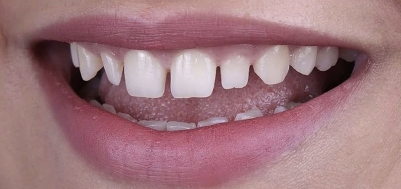 Βελτίωση χαμόγελου με όψεις πορσελάνης 2 πριν